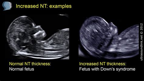 nuchal fold thickness measurement at 14 weeks|increased nuchal fold thickness.